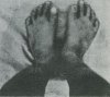 26: Abnormal (Human) feet of an Australoid. (Dr. W. Tschernezky)
