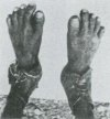 27: Abnormal feet of a Caucasoid. (Freiherr E. von Eickstedt)