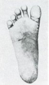 28: Sole of foot of an African Negrillo (Pigmy). (Freiherr E. von Eickstedt)