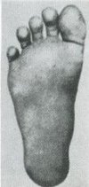 29: Sole of foot of adult Negroid man, used to going barefoot. (Dr. W. Tschernezky)